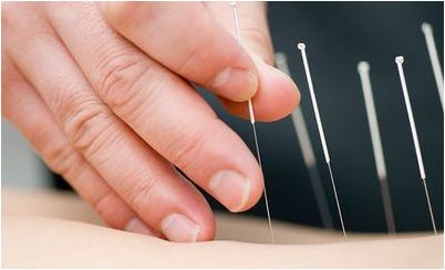 иглоукалывание