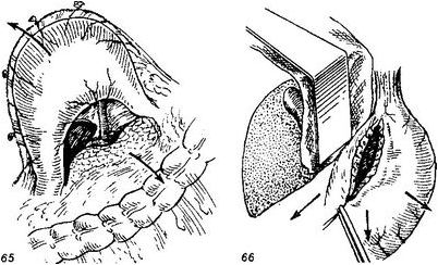 снижению веса