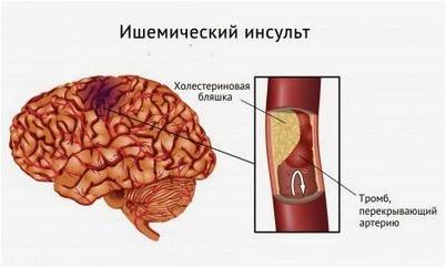 инсульт
